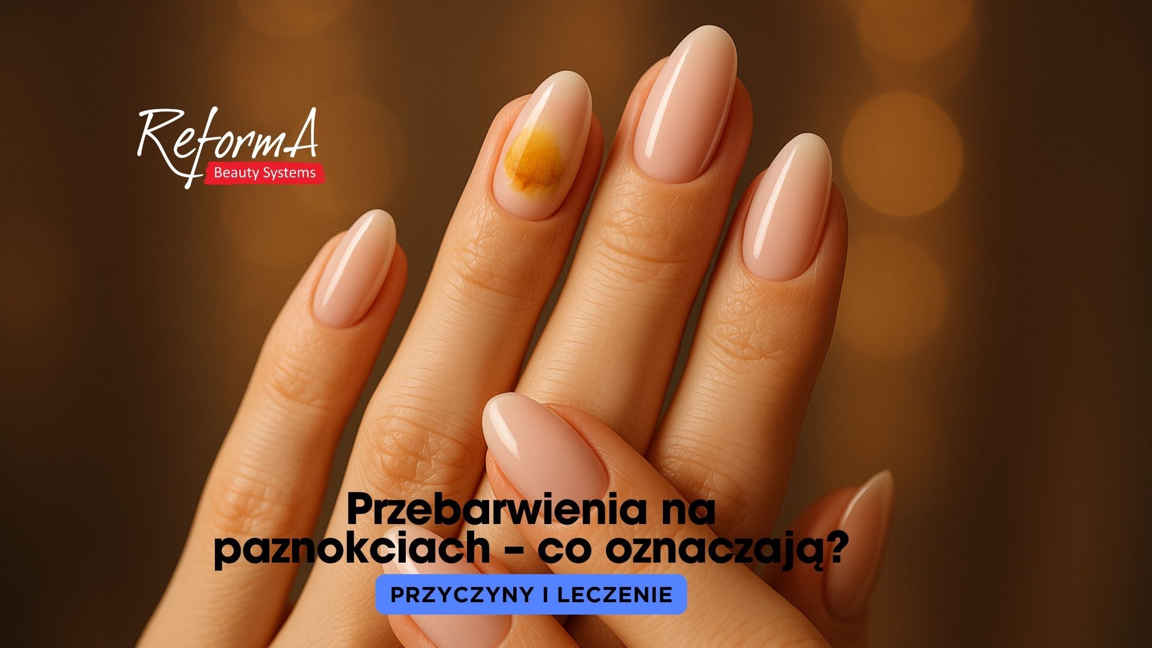 Przebarwienia na paznokciach – co oznaczają? Przyczyny i leczenie