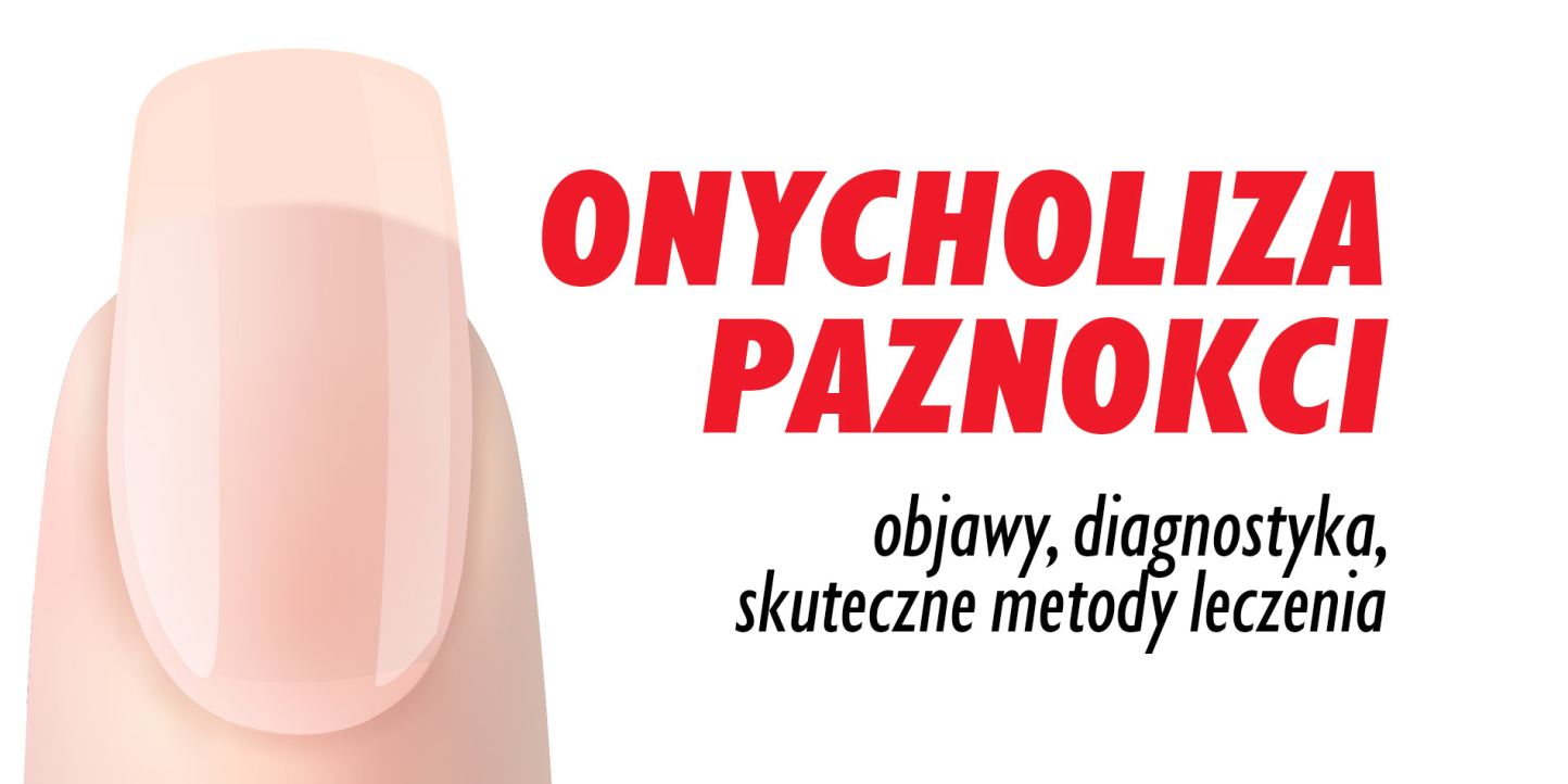 Onycholiza paznokci - objawy, diagnostyka i skuteczne metody leczenia | Reforma